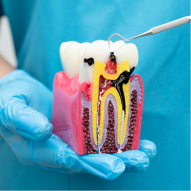 Root Canal Treatment