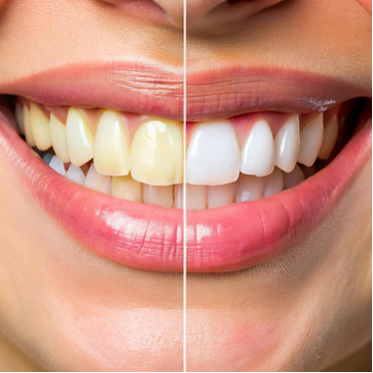 Teeth Whitening